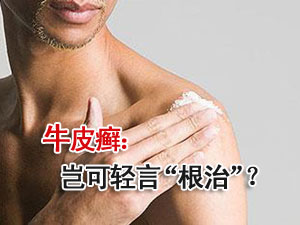牛皮癣 岂可轻言“根治”？